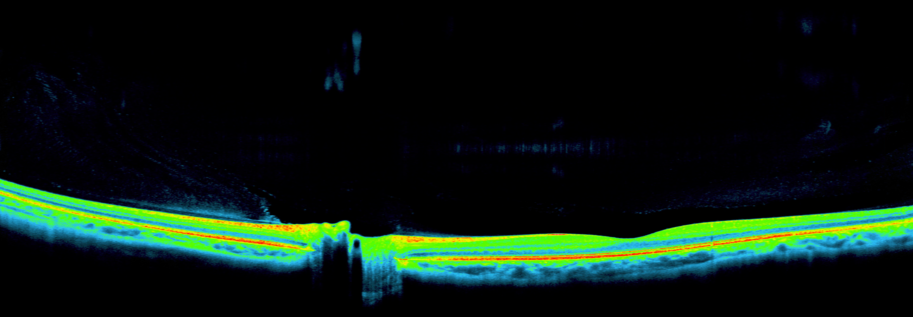OCT Longitudinal Spine